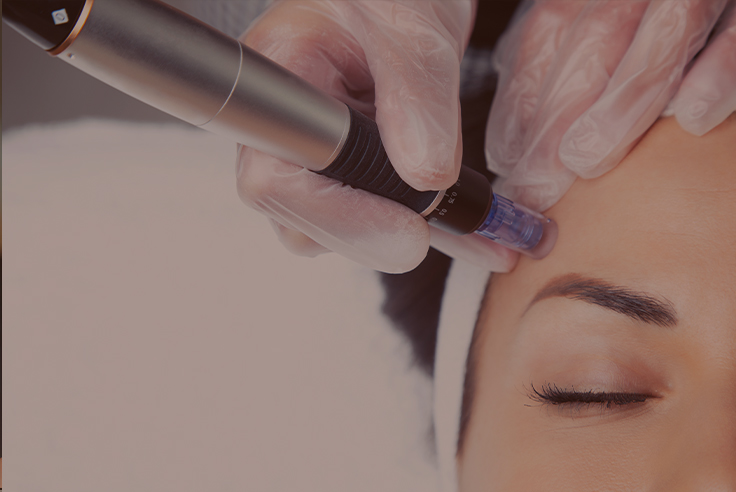 Microneedling